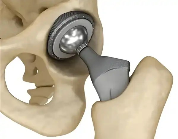 Titanium Orthopedic Implants Titanium Orthopedic Implants